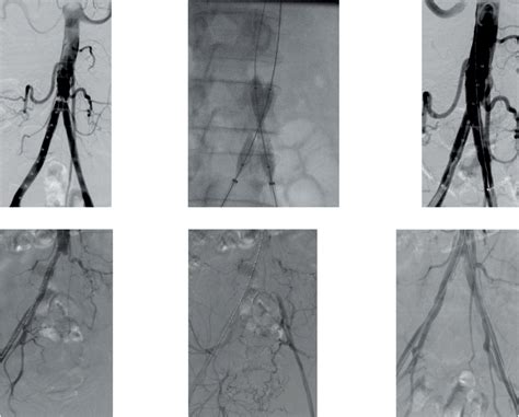 Aortoiliac Intervention For Pad A Angiogram Showing High Grade