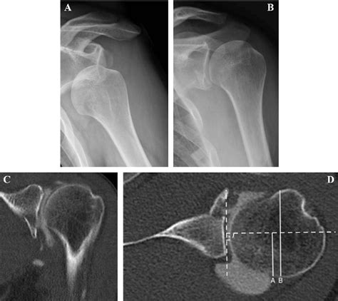 Figure 1 From Nonoperative Treatment Of Anterior Glenoid Rim Fractures