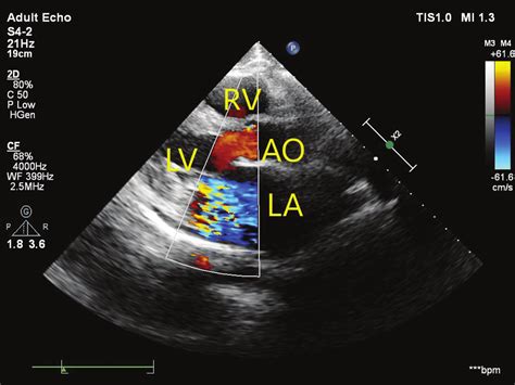 Preoperative Transthoracic Echocardiography Parasternal Long Axis