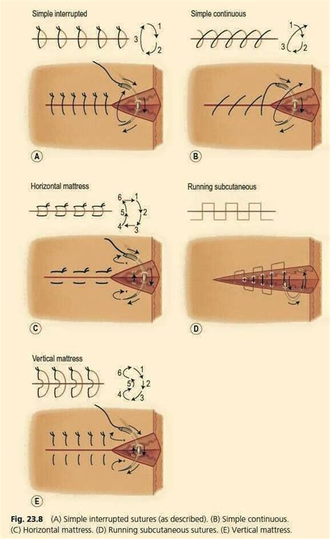 Suture Chart Suture Types Surgical Suture Sutures Images And Photos