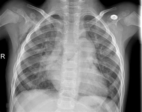 Github Aaronmil Chest Xray Deep Learning Classification Of Chest X Rays Using Multiple