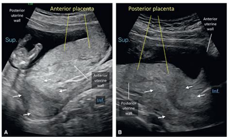 Placenta and Umbilical Cord | Radiology Key