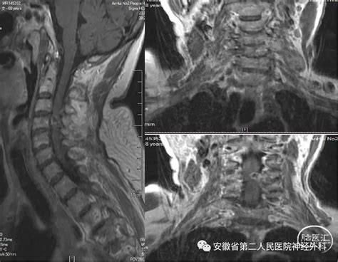 安徽省第二人民医院神经外科丨神经电生理监测精准“护航”下微创手术治疗脊柱脊髓肿瘤 脑医汇 神外资讯 神介资讯