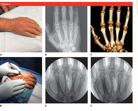 Human And Other Mammalian Bite Injuries Of The Hand Evaluation And