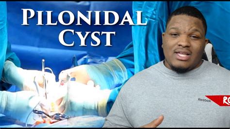 Pilonidal Cyst Story Post Surgery Experience YouTube