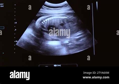 2D Ultrasound Display Of 28 Weeks Pregnant Fetus Ultrasound Image That