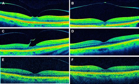 Bilateral Spontaneous Release Of Vitreomacular Traction Ophthalmology