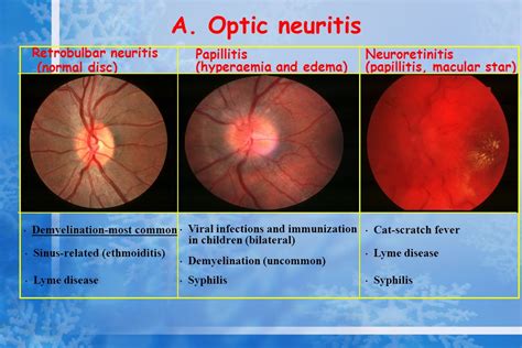 OPTIC NERVE DISEASES VISUAL FIELD Dr Canan Aslı Yıldırım