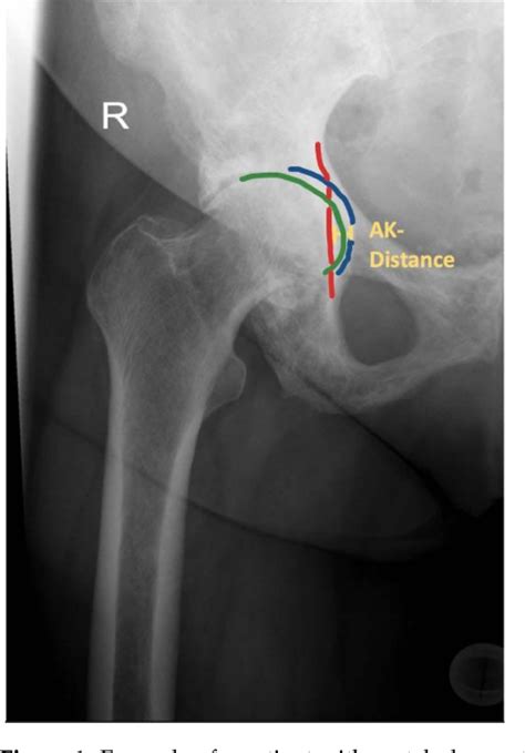 Figure From The Direct Anterior Approach Daa As A Standard Approach