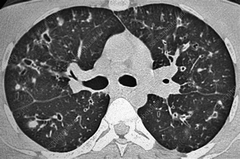 Cystic fibrosis, CT scan - Stock Image - C014/7024 - Science Photo Library