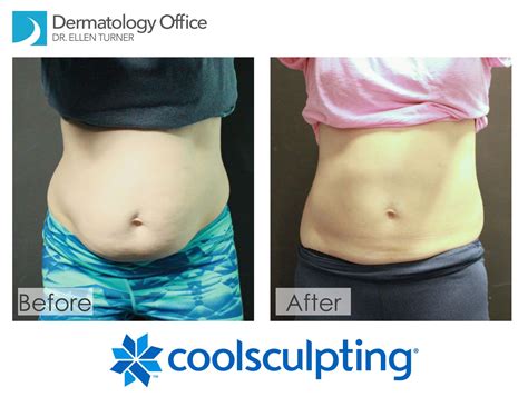 CoolSculpting Dallas Texas Dr Ellen Turner