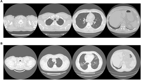 Example images showing (A) healthy and (B) COVID-19 lungs taken from ...