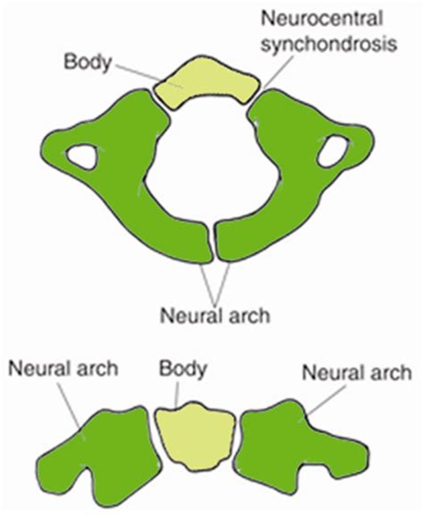 Atlas Fractures And Transverse Ligament Injuries Spine Orthobullets