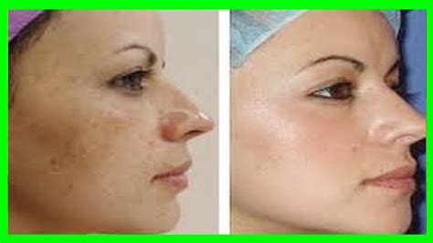 Receita Caseira Para Acabar Com Manchas De Melasma Como Clarear A Pele