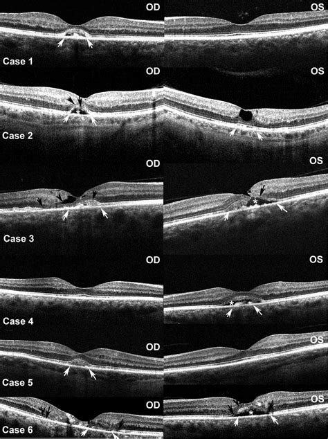 Ultrastructural And Clinical Evidence Of Subretinal Debris Accumulation