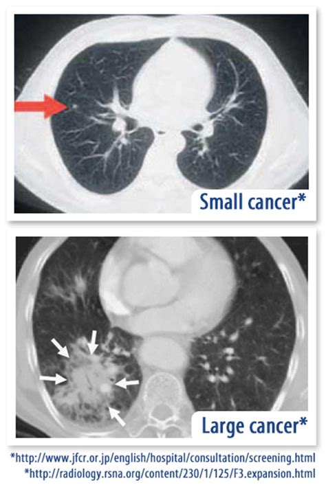 Lung Cancer - Self Regional Healthcare | Greenwood, SC