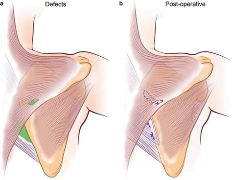 Scapular Muscle Detachment Musculoskeletal Key