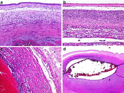 Ascending Infection High Vaginal Swab Grew E Coli From A Placental