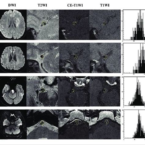 High Resolution Magnetic Resonance Imaging HrMRI Images And Histogram