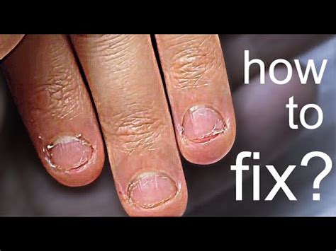 How To Fix Short Bitten Nails Extreme Short Nail Plate Transformation