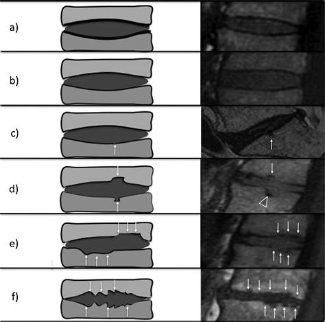 Mr Imaging Of Degenerative Disc Disease European Journal Of Radiology