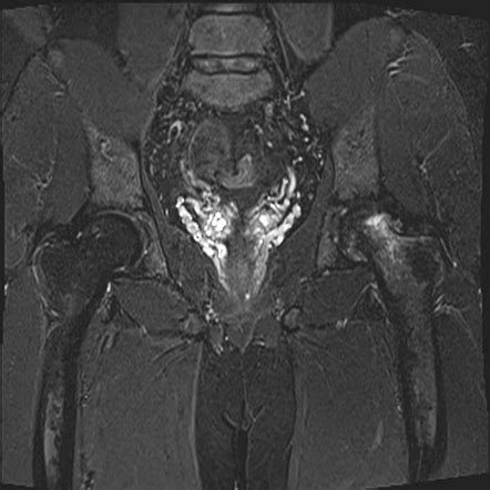 Subchondral Insufficiency Fracture Femoral Head Image Radiopaedia Org