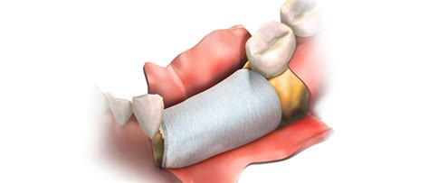 Bone And Sinus Grafting Austin Implants And Periodontics