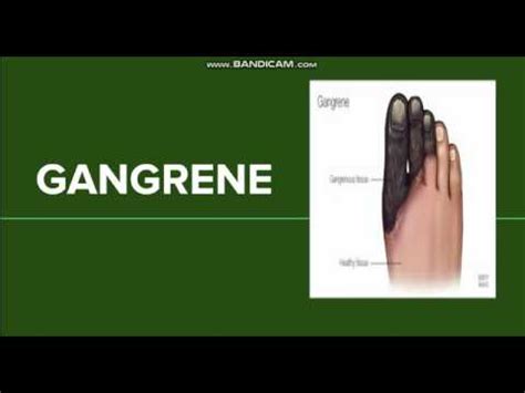 Wet Gangrene - Causes, Symptoms And Treatment | Diseases and diagnoses 2024