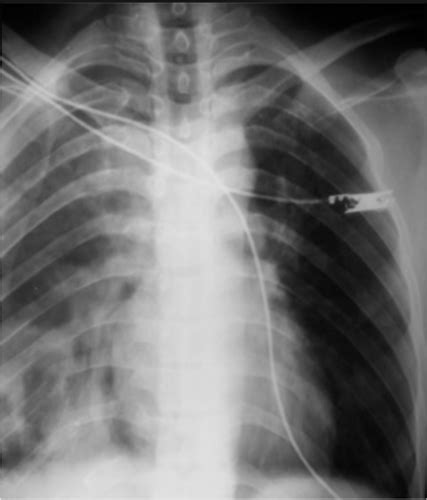 Em Chest Trauma Flashcards Quizlet