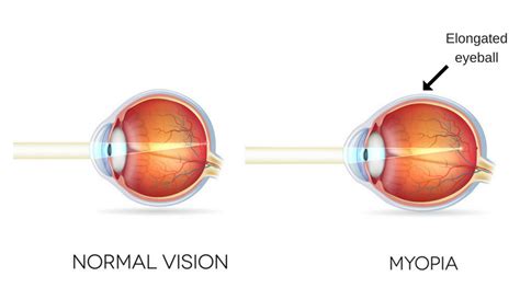 Orthokeratology Orthok San Diego Myopia Control New Optix Optometry