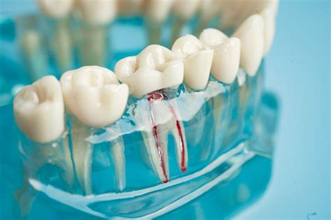 The Latest Innovations In Root Canal Therapy For 2024