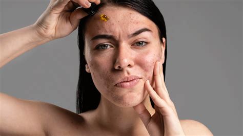 How To Treat Acne Caused By A Hormonal Imbalance Doctor Asky