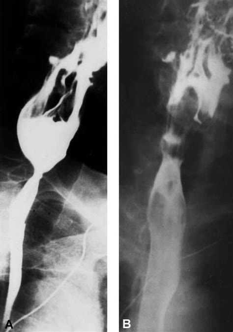 Primary Cricopharyngeal Dysfunction Treatment With Balloon Catheter