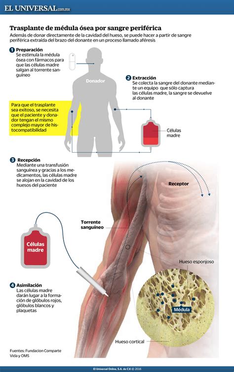 Trasplante De Médula ósea Por Sangre Periférica