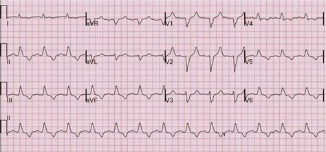 Dr. Smith's ECG Blog: Weakness, prolonged PR interval, wide complex, ventricular tachycardia