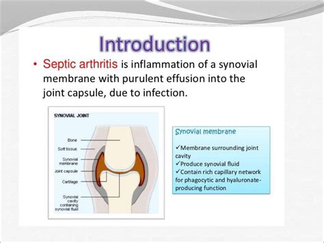 Septic Arthritis