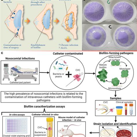 A Schematic Of The Subclinical Theory Of Capsular Contracture