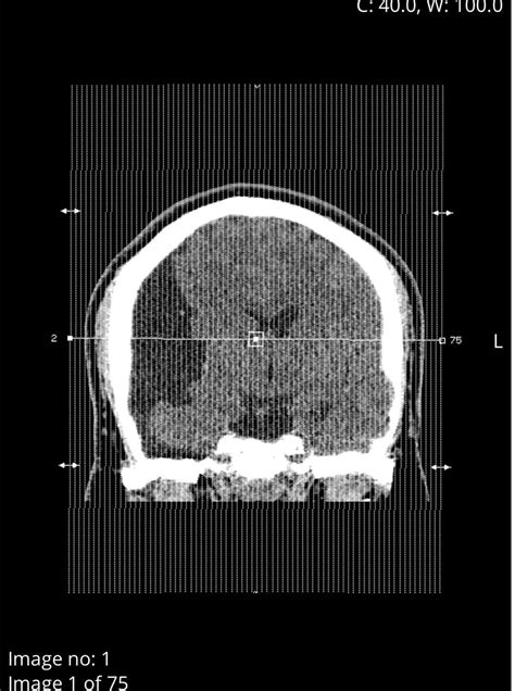 Incidental Finding Arachnoid Cyst In Brain Rradiology