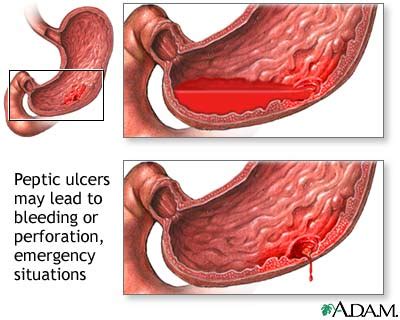 Gastric Ulcer Overview