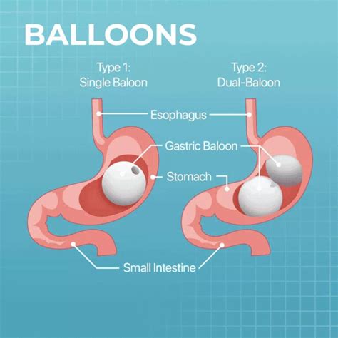 Gastric Balloons Turkey Medical Holidays