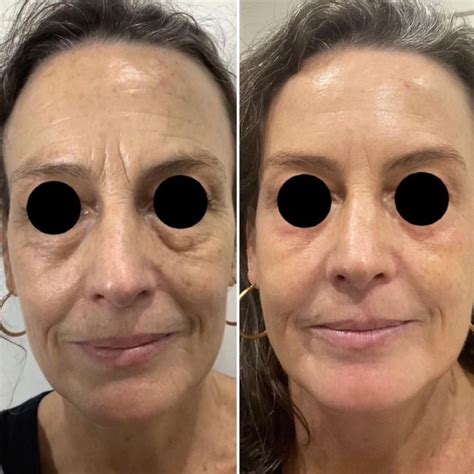 Eco2 Fractional Skin Resurfacing Full Face 1500 Lismore Destiny