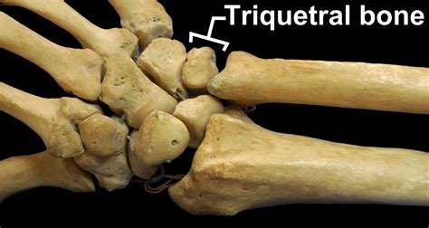 Triquetral Body Fractures - Rxharun