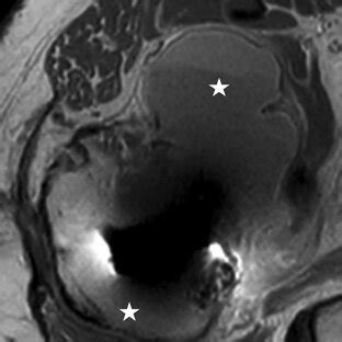 Pre Operative Axial T1 Weighted MRI Sequence Of Case Two Depicting The