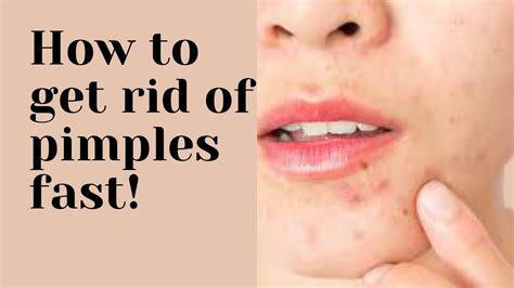 How To Get Rid Of Pimples Fast Easy Ways To Dry Out Your Acne In