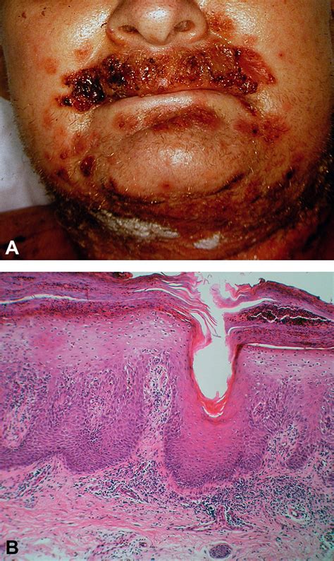 Glucagon Cell Adenomatosis A New Entity Associated With Necrolytic