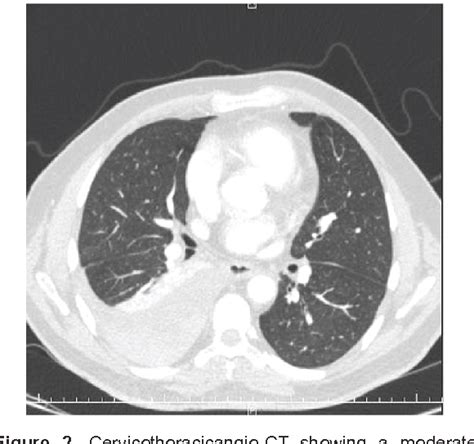 Figure From Spontaneous Hemothorax In A Patient With Von