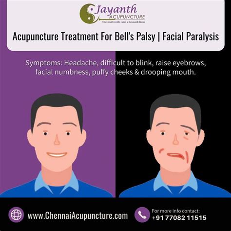 Facial Palsy Treatment At Rs 600session In Chennai Id 6760453433