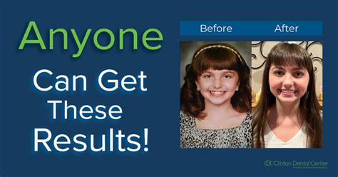 Braces Success Story Clinton Dental Center