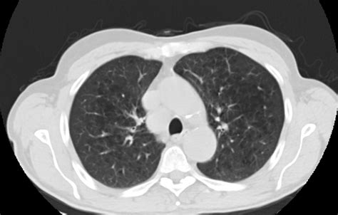 Lug Detection 20233 Instance Segmentation Dataset By Object Detection Lung