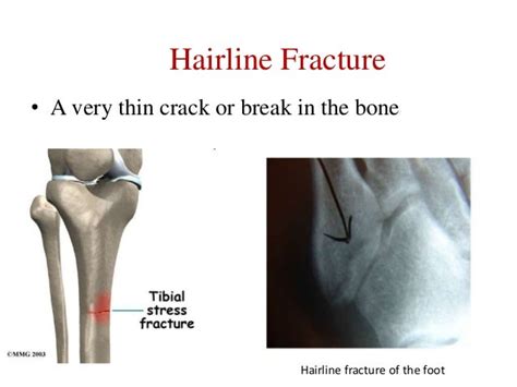 Hairline Fracture